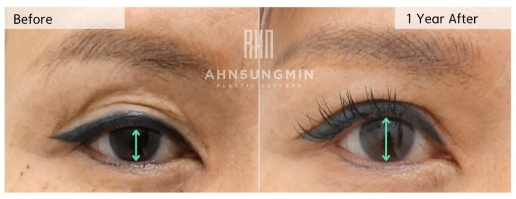 Before and 1 year after ptosis revision and upper eyelid fat repositioning showing improved eyelid opening and reduced hollowing without added volume