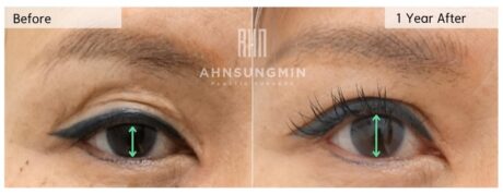 Ptosis Surgery Limits: When Skin Shortage Defines the Outcome.
