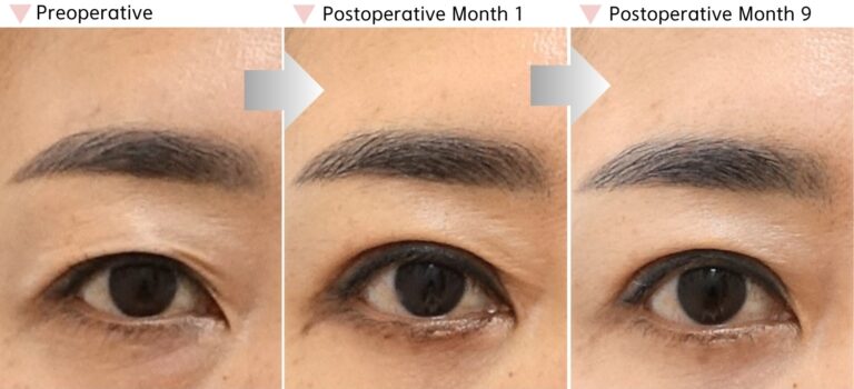 Upper eyelid surgery recovery showing temporary scar contracture at postoperative month 1 and gradual softening by postoperative month 9