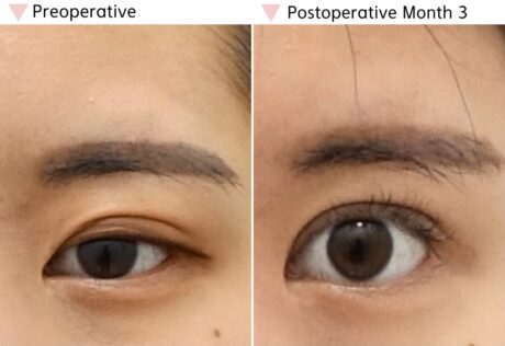 Why Does Double Eyelid Surgery Fail?