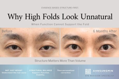 High Fold Eyelid Revision with Ptosis Correction | 6-Month Result
