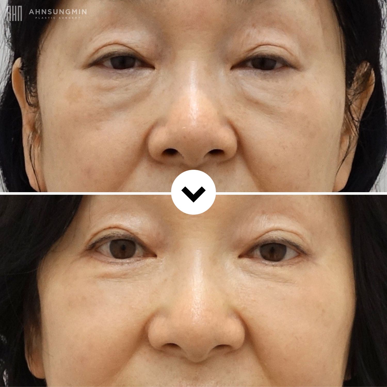Before and after lower blepharoplasty showing natural under-eye volume without postoperative hollowing through fat preservation and structural support.