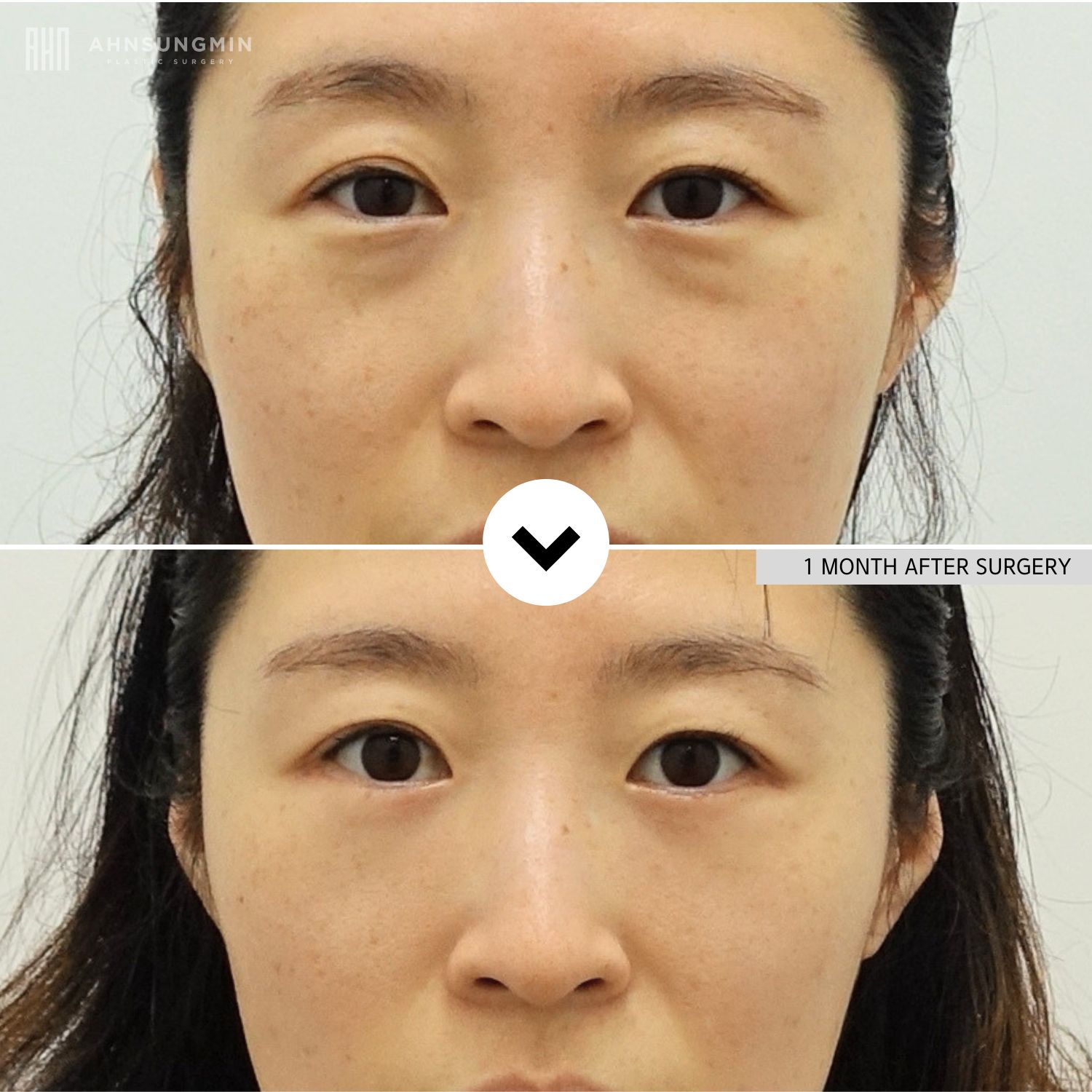 Before and 1 month after lower eyelid fat repositioning in a young woman showing smoother under-eye contours and reduced eye bags.
