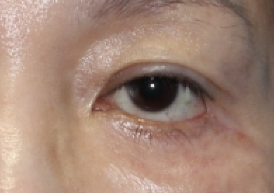 Lower eyelid tension caused by excessive skin removal after lower eyelid surgery