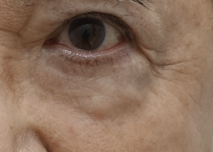 Orbital septum damage causing loss of orbital fat support in the lower eyelid