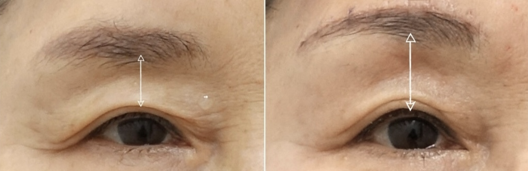 brow lift surgery before and after showing increased brow-to-eye distance