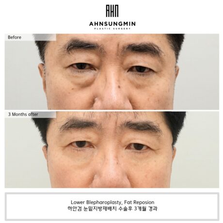 Blood pressure is closely related to lower eyelid surgery.