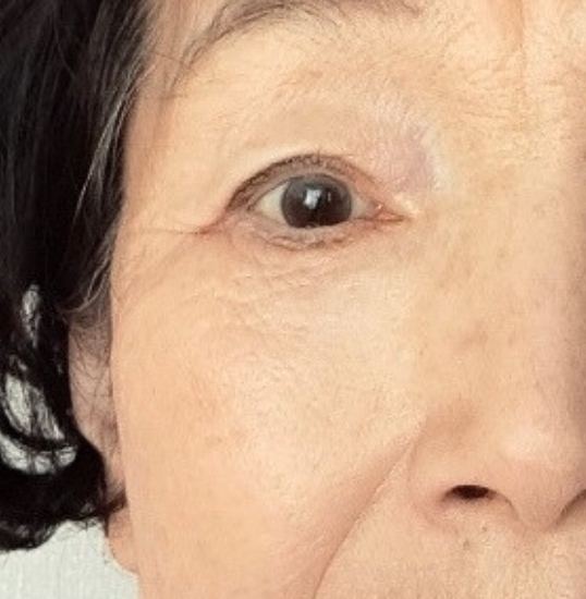 lower Blepharoplasty 2 Months after