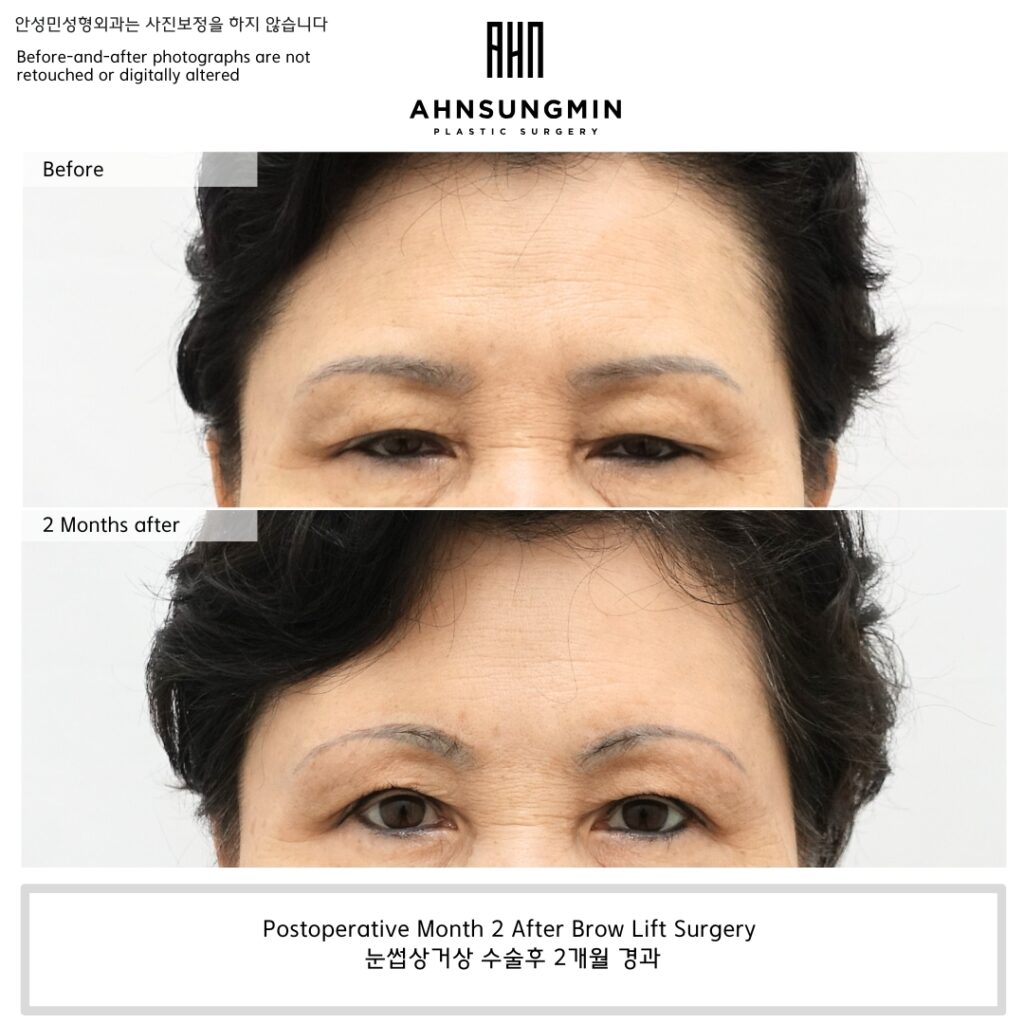 Postoperative Month 2 After Supra Brow Lift (Direct Brow Lift) Surgery at Ahnsungmin Plastic Surgery in Seoul