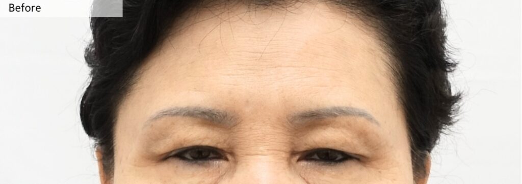 Preoperative Condition with Low Brow Position and Tired Eye Appearance