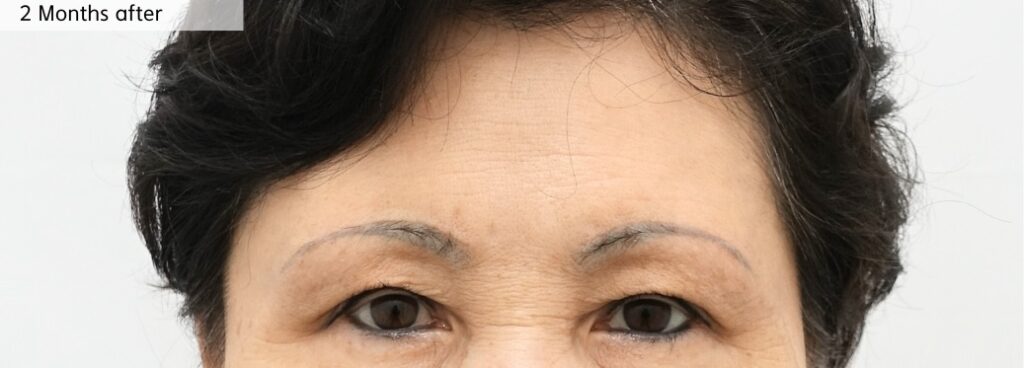 Brow Position Improvement After Supra Brow Lift Surgery