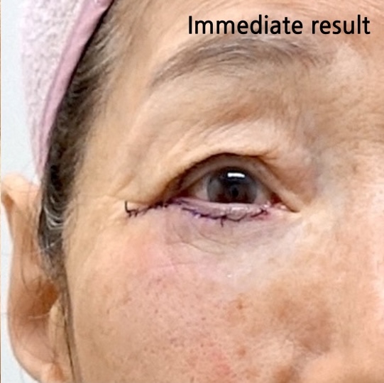 lower Blepharoplasty