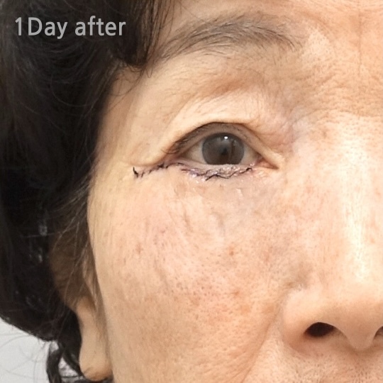 lower Blepharoplasty Immediate result ahnsungminplastic surgery