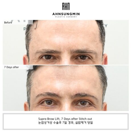 Is Brow Lift a suitable surgery for men as well?